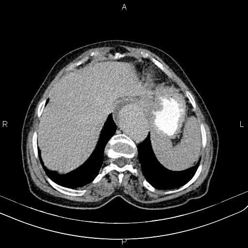 File:Aortic aneurysm and Lemmel syndrome (Radiopaedia 86499-102554 Axial C+ delayed 12).jpg