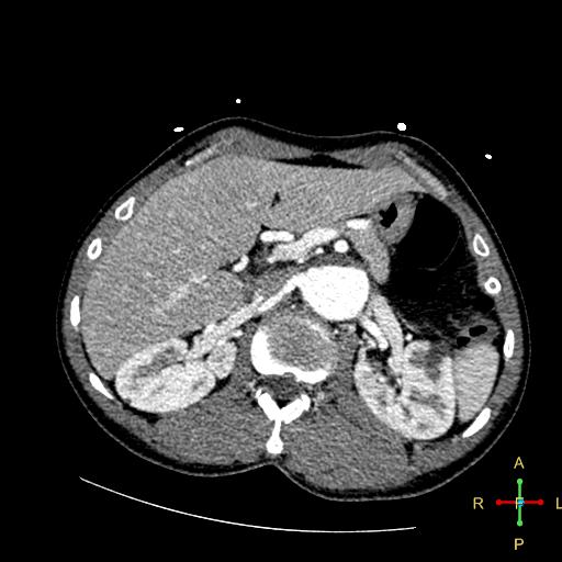 File:Aortic aneurysm and penetrating ulcer (Radiopaedia 23590-23704 A 32).jpg