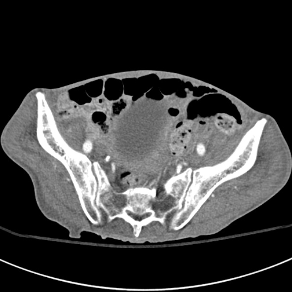 File:Aortic aneurysm with spinal destruction (Radiopaedia 42301-45410 A 86).jpg