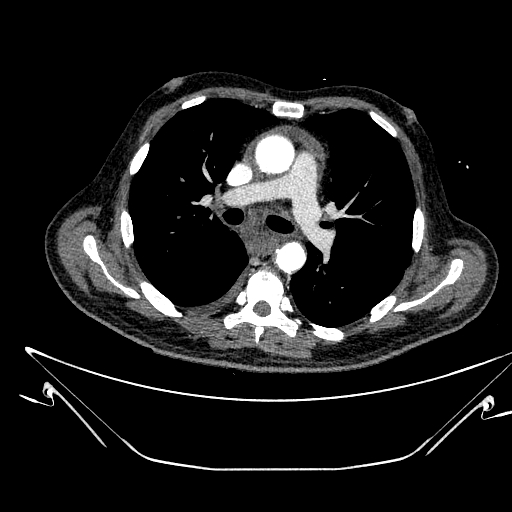 Aortic arch aneurysm (Radiopaedia 84109-99365 B 277).jpg