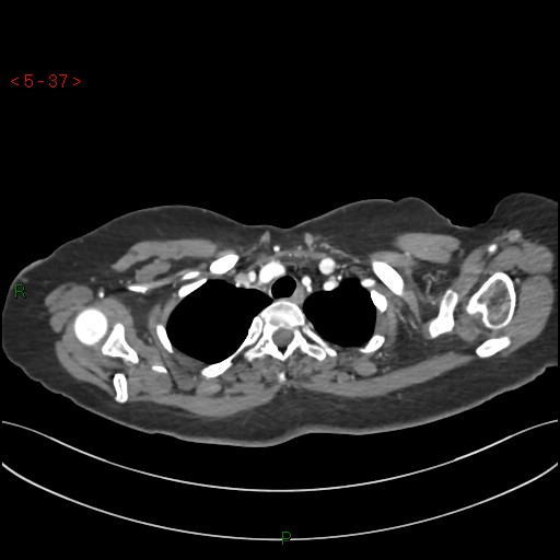 Aortic arch origin of left vertebral artery (Radiopaedia 51520-57286 A 36).jpg