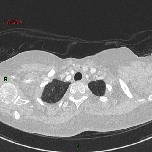 Aortic arch origin of left vertebral artery (Radiopaedia 51520-57286 Axial lung window 29).jpg