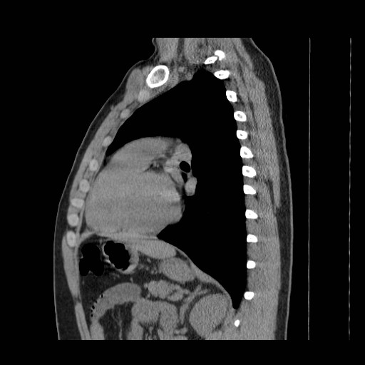 File:Aortic arch stent (Radiopaedia 30030-30595 B 21).jpg