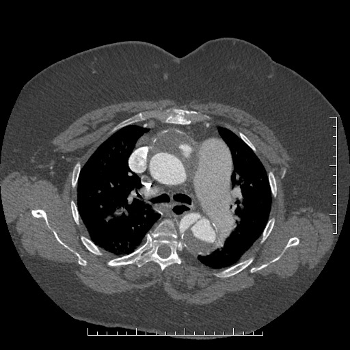 File:Aortic dissection- Stanford A (Radiopaedia 35729-37268 A 28).jpg