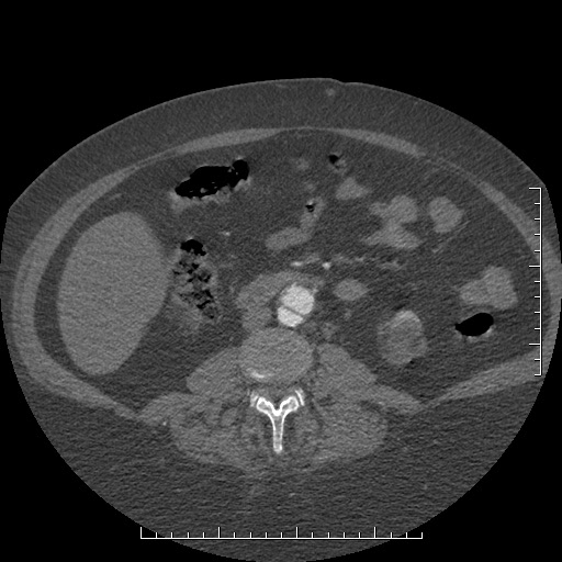 File:Aortic dissection- Stanford A (Radiopaedia 35729-37268 C 19).jpg