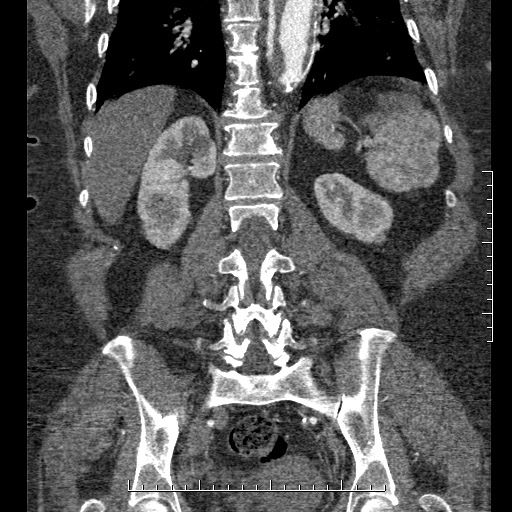 File:Aortic dissection- Stanford A (Radiopaedia 35729-37268 F 9).jpg