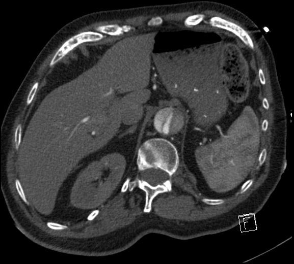 Aortic dissection (CTPA) (Radiopaedia 75506-86750 A 89).jpg