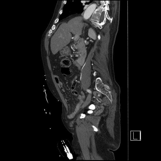 Aortic dissection (CTPA) (Radiopaedia 75506-86750 G 41).jpg