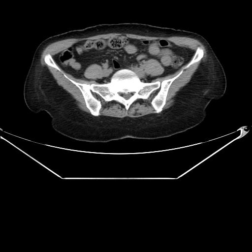 Aortic dissection (Radiopaedia 25350-25604 B 60).jpg