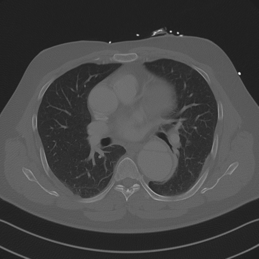 File:Aortic dissection (Radiopaedia 50763-56234 Axial bone window 53).png