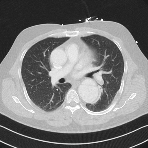 File:Aortic dissection (Radiopaedia 50763-56234 Axial lung window 33).png