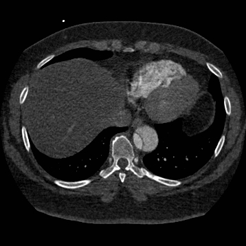 File:Aortic dissection (Radiopaedia 57969-64959 A 233).jpg