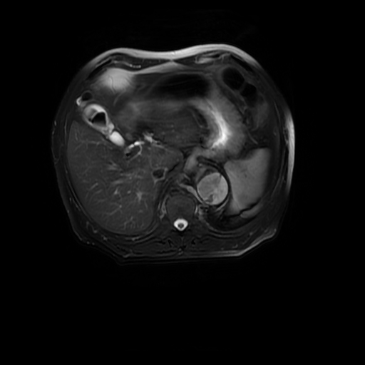 File:Aortic dissection - Stanford A - DeBakey I (Radiopaedia 23469-23551 Axial T2 fat sat 17).jpg