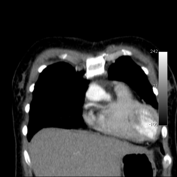 Aortic dissection - Stanford type A (Radiopaedia 29247-29659 B 14).jpg