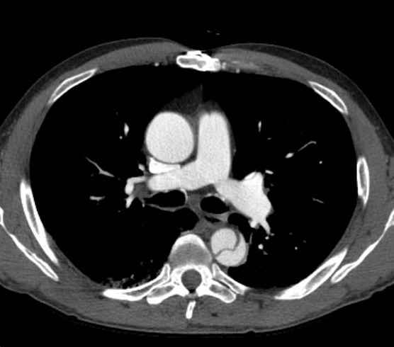 Aortic dissection - Stanford type B (Radiopaedia 73648-84437 A 42).jpg