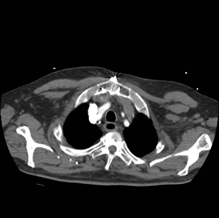 Aortic dissection with rupture into pericardium (Radiopaedia 12384-12647 A 10).jpg