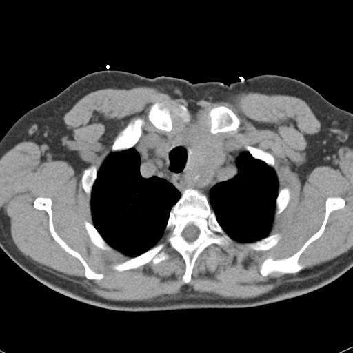 Aortic intramural hematoma (Radiopaedia 31139-31838 Axial non-contrast 9).jpg