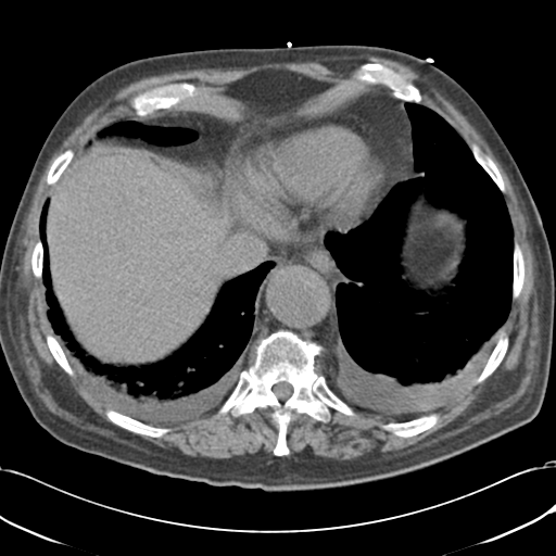 File:Aortic intramural hematoma (Radiopaedia 34260-35540 Axial non-contrast 50).png