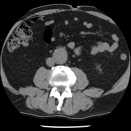Aortic intramural hematoma (type B) (Radiopaedia 79323-92387 Axial non-contrast 78).jpg