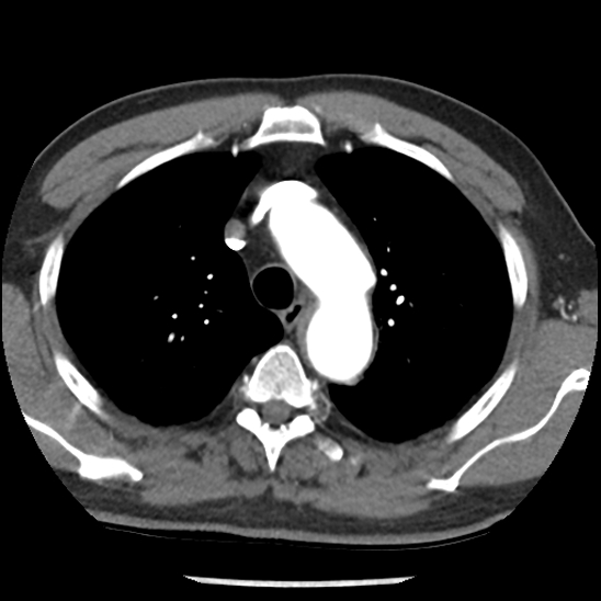 Aortic intramural hematoma (type B) (Radiopaedia 79323-92387 B 13).jpg