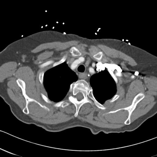 File:Aortic intramural hematoma from penetrating atherosclerotic ulcer (Radiopaedia 31137-31836 A 10).jpg