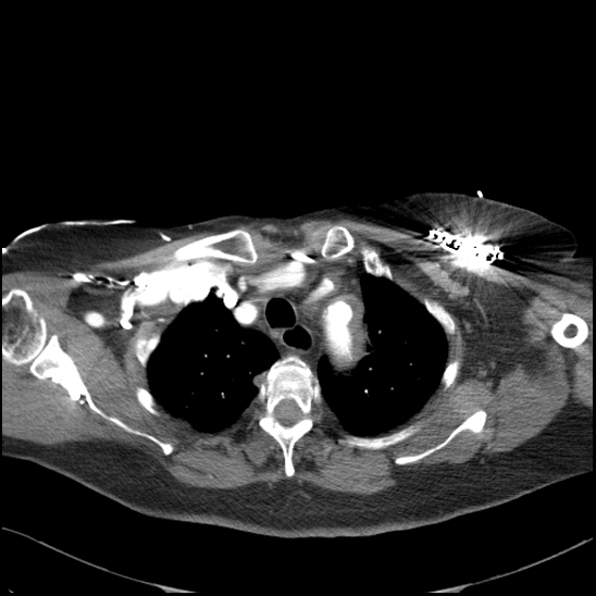 Aortic intramural hematoma with dissection and intramural blood pool (Radiopaedia 77373-89491 B 34).jpg