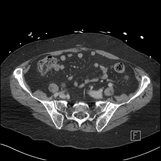 Aortic intramural hematoma with dissection and intramural blood pool (Radiopaedia 77373-89491 E 72).jpg