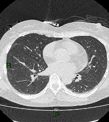 File:Aortic valve endocarditis (Radiopaedia 87209-103485 Axial lung window 59).jpg