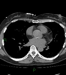 Aortic valve endocarditis (Radiopaedia 87209-103485 Axial non-contrast 59).jpg