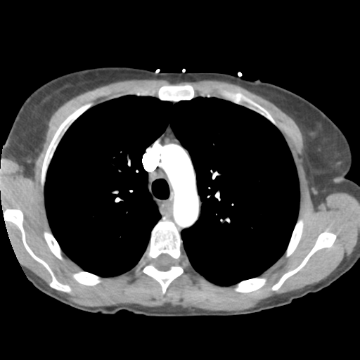 Aortic valve non-coronary cusp thrombus (Radiopaedia 55661-62189 B 16).png