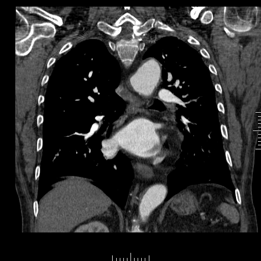 File:Aorto-coronary bypass graft aneurysms (Radiopaedia 40562-43157 B 29).png