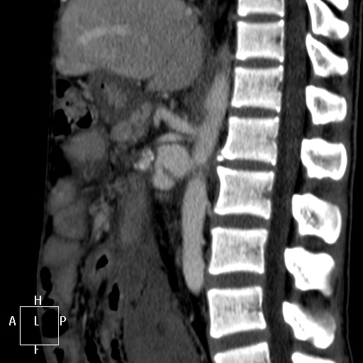 File:Aorto-left renal vein fistula (Radiopaedia 45534-49628 C 34).jpg