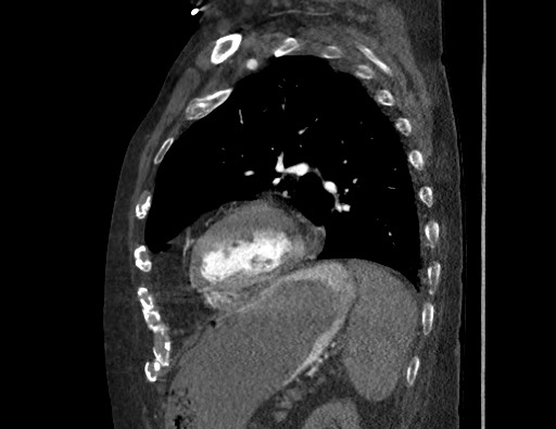 Aortoesophageal fistula with endovascular repair (Radiopaedia 73781-84592 Sagittal C+ CTPA 142).jpg