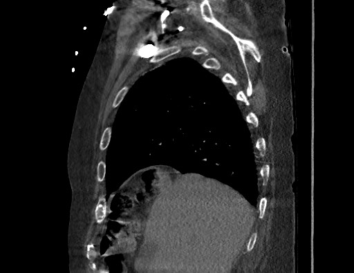 Aortoesophageal fistula with endovascular repair (Radiopaedia 73781-84592 Sagittal C+ CTPA 34).jpg
