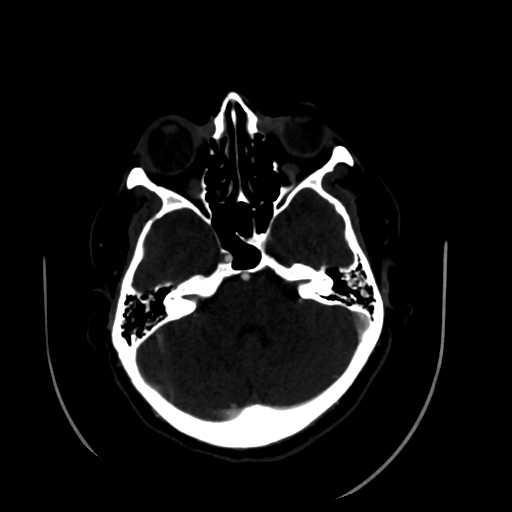 Aplasia of the internal carotid artery (Radiopaedia 61082-68960 A 20).jpg
