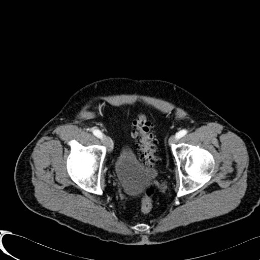 Appendiceal adenocarcinoma complicated by retroperitoneal abscess (Radiopaedia 58007-65039 B 129).jpg