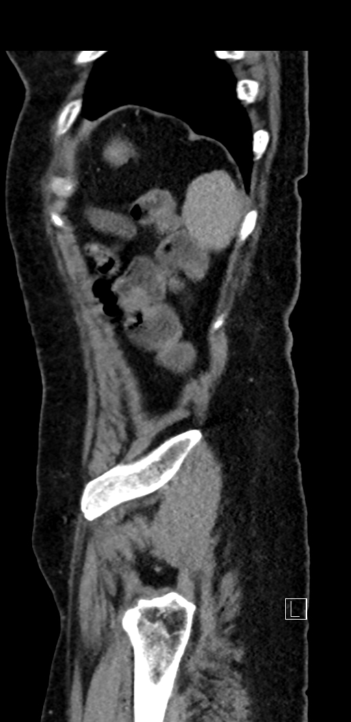 Appendiceal hemorrhage (Radiopaedia 70830-81025 Sagittal C+ delayed 98).jpg