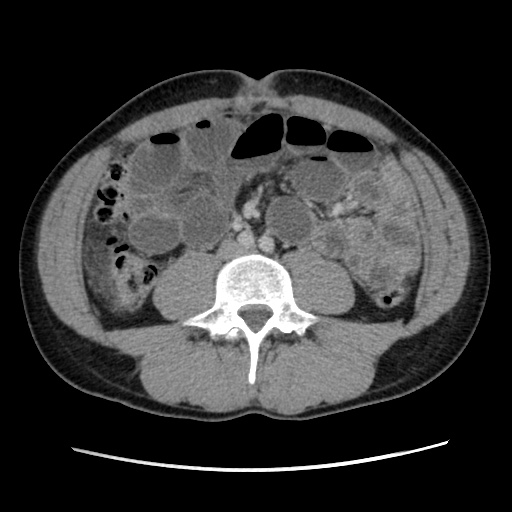 File:Appendicitis complicated by post-operative collection (Radiopaedia 35595-37114 A 49).jpg