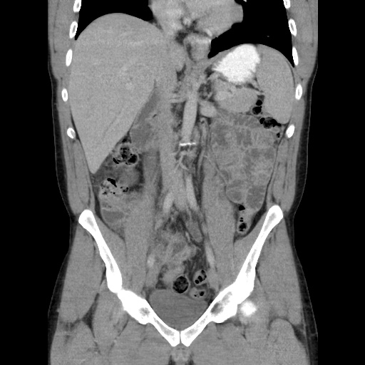 Appendicitis complicated by post-operative collection (Radiopaedia 35595-37114 B 28).jpg