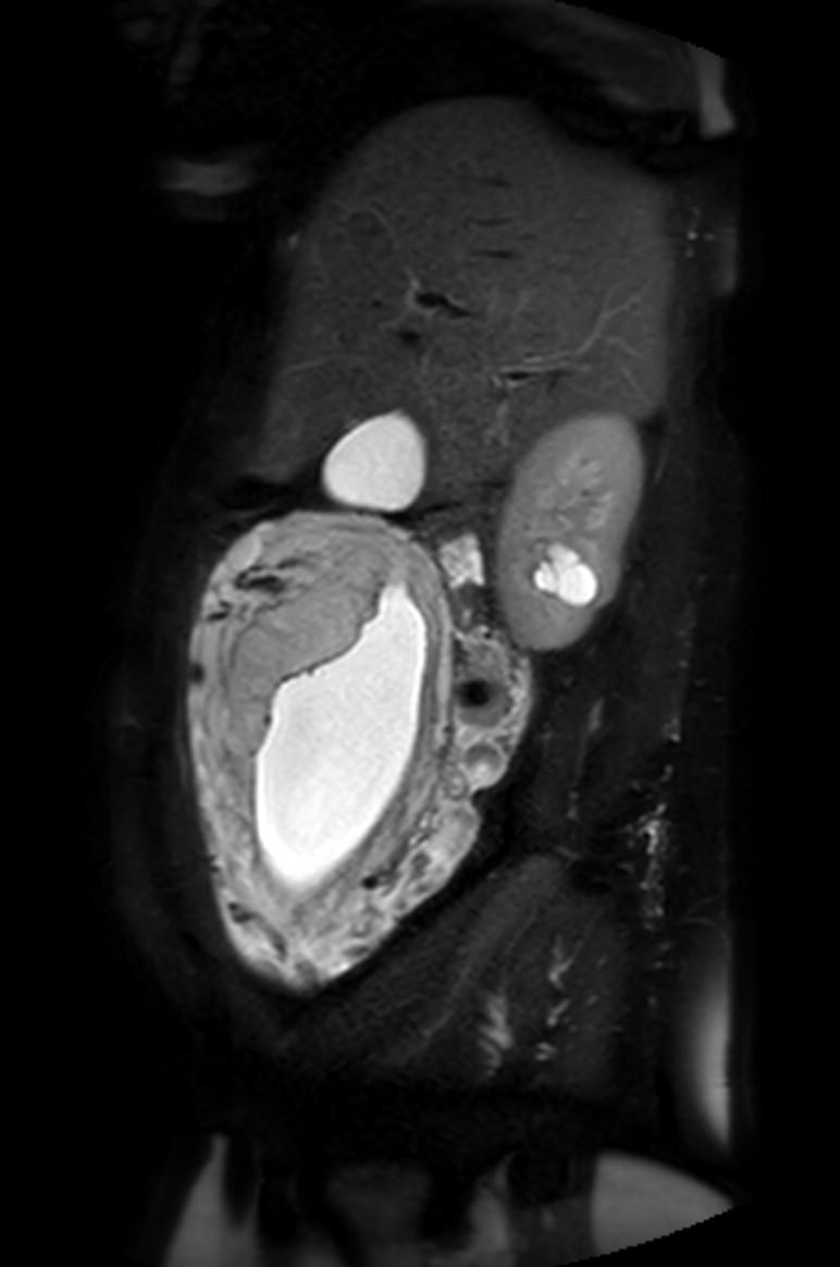 Appendicitis in gravida (MRI) (Radiopaedia 89433-106395 Sagittal T2 SPAIR 47).jpg