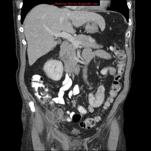 File:Appendicitis mass in inguinal hernia (Radiopaedia 26858-27029 B 27).jpg