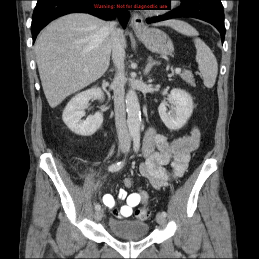 File:Appendicitis mass in inguinal hernia (Radiopaedia 26858-27029 B 37).jpg