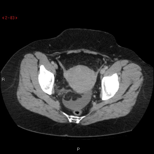 Appendicitis with microperforation- promontoric type (Radiopaedia 27268-27442 C 71).jpg