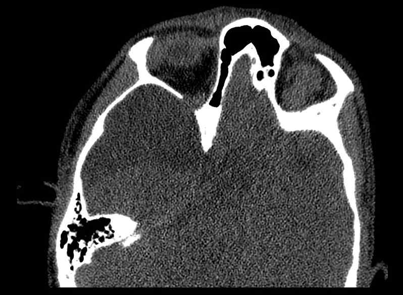 Arachnoid cyst- extremely large (Radiopaedia 68741-78450 Axial bone window 32).jpg