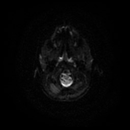 Arachnoid cyst - middle cranial fossa (Radiopaedia 86780-102938 Axial DWI 56).jpg