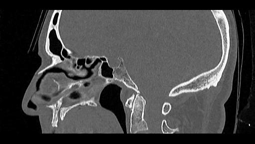 Arcuate foramen (Radiopaedia 89833-106944 Sagittal bone window 58).jpg