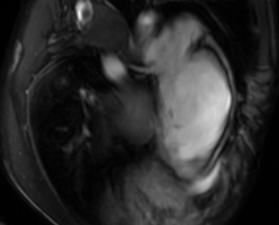 File:Arrhythmogenic right ventricular cardiomyopathy (Radiopaedia 69564-79464 4ch cine 124).jpg