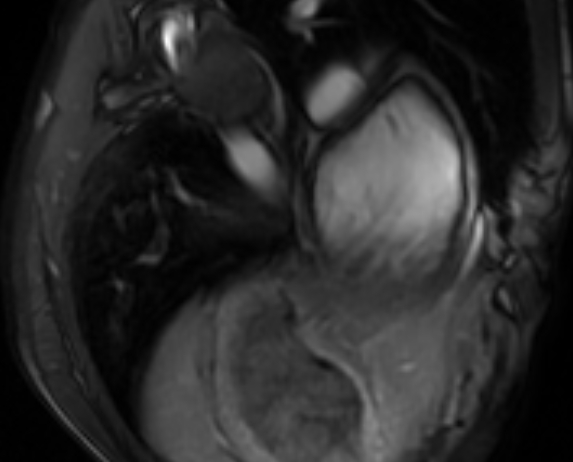 File:Arrhythmogenic right ventricular cardiomyopathy (Radiopaedia 69564-79464 4ch cine 158).jpg