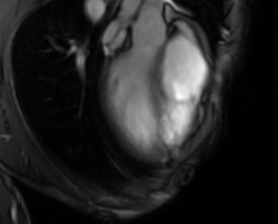 Arrhythmogenic right ventricular cardiomyopathy (Radiopaedia 69564-79464 4ch cine 18).jpg