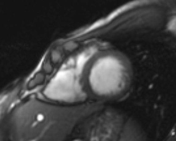Arrhythmogenic right ventricular cardiomyopathy (Radiopaedia 69564-79464 short axis cine 81).jpg